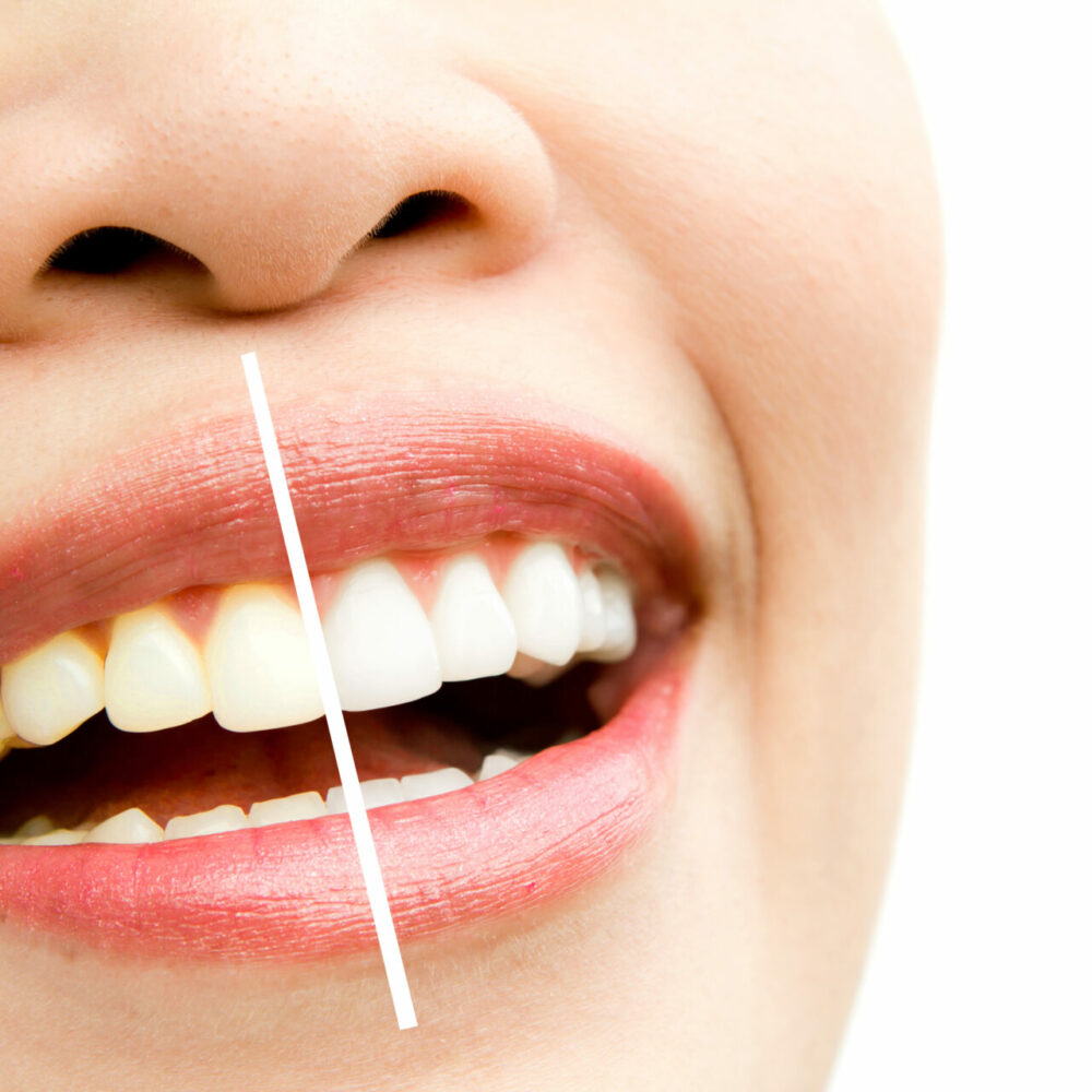 How Much Do Dentures Cost In Australia? Kensington Dental Care